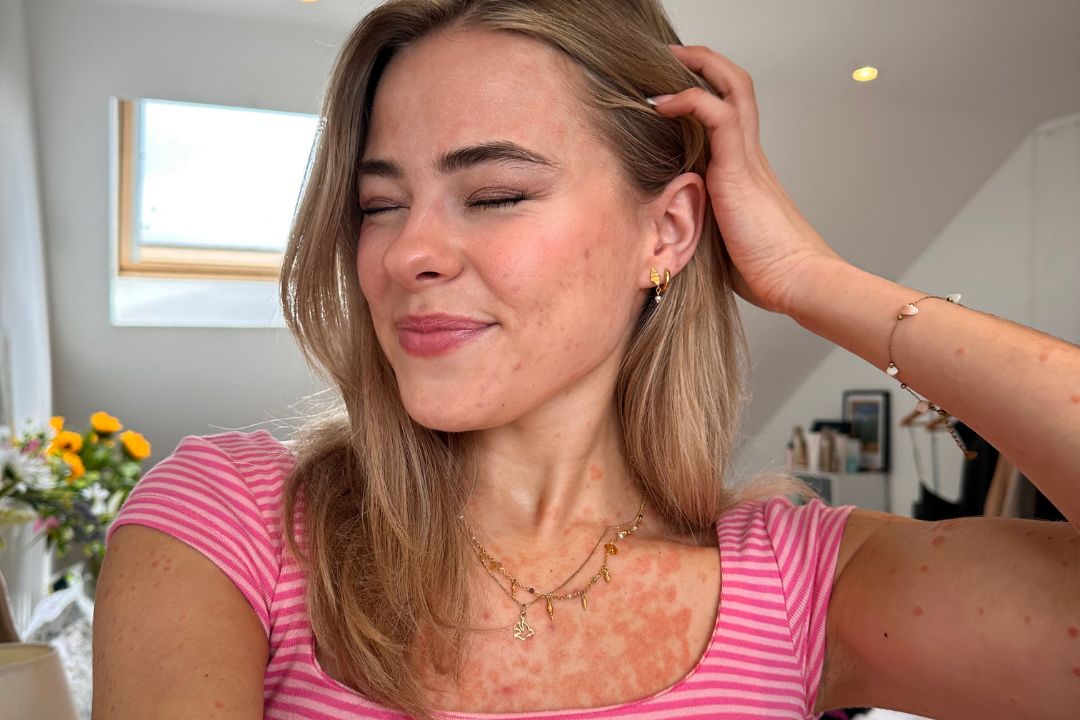 A Sit Down With SkinWithSoph: Living With Psoriasis