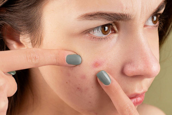 Discover Our Best Blemish Skincare Products For Acne-Prone Skin