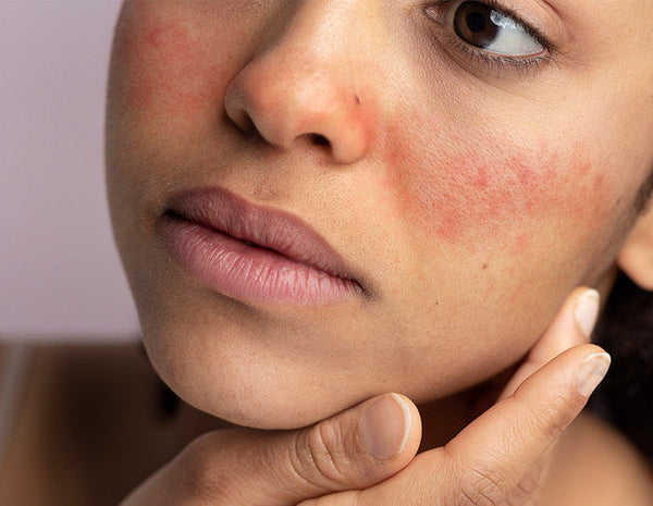 how to treat rosacea