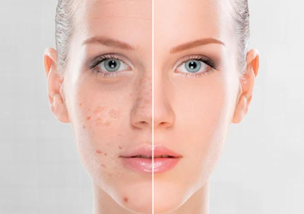 Fight Dark Spots With The Best Vitamin C Serum And Moisturisers For Hyperpigmentation