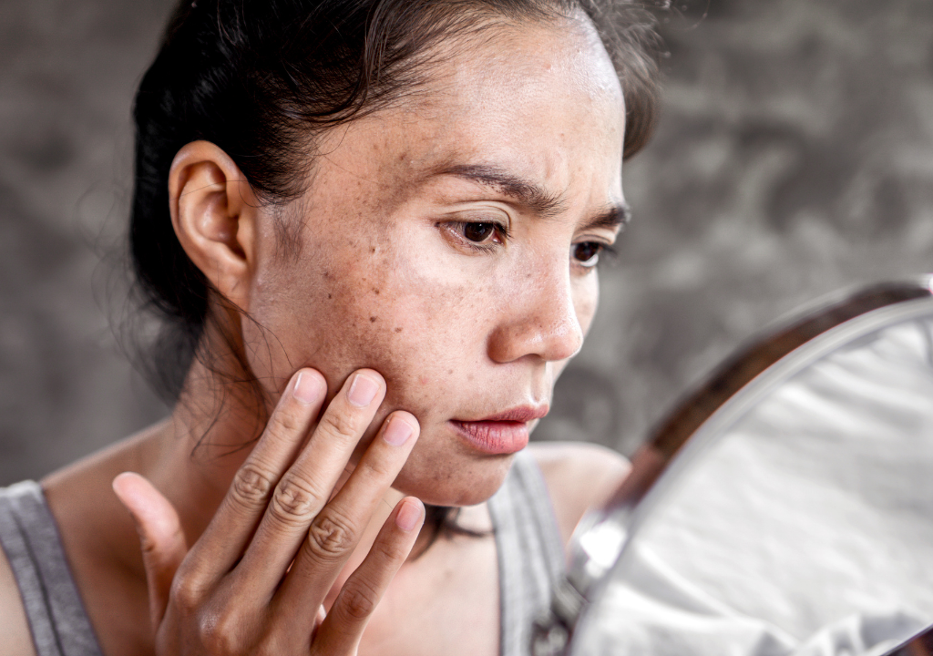 Melasma vs Acne: What Are the Differences and How to Treat Them?