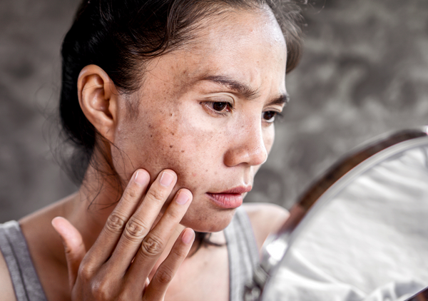 Woman looking at hyperpigmentation in the mirror