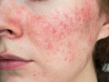 Rosacea Skin