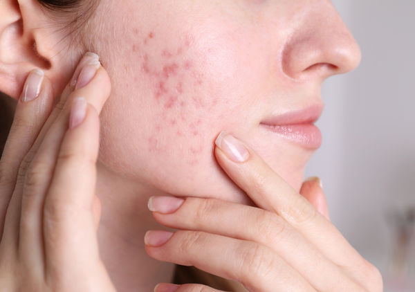 Makeup & Acne: Does Makeup Cause Breakouts? How to Choose Acne-Safe Products