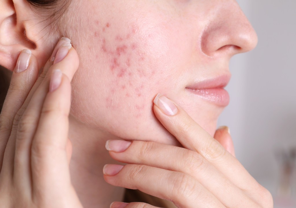 Woman inspecting acne scars