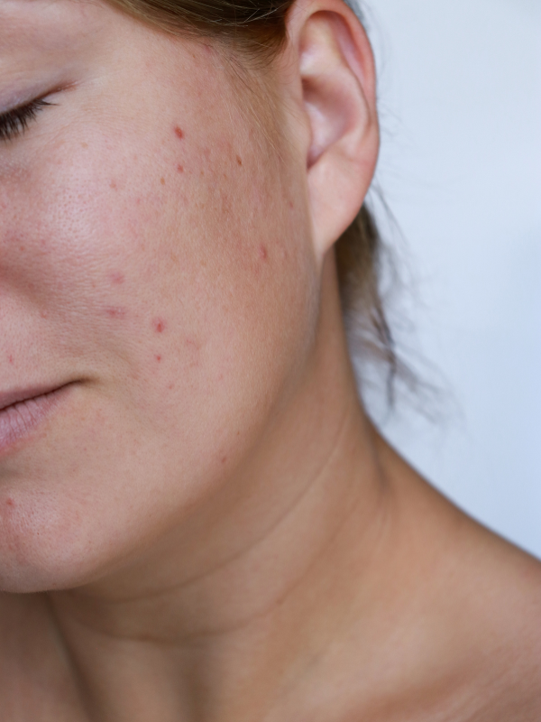 Facial acne on a woman's cheeks.