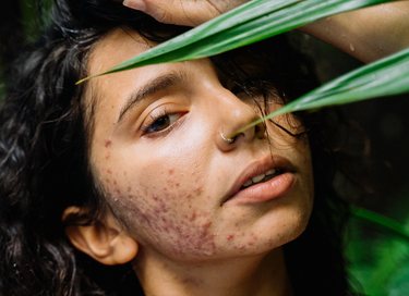 A woman with acne on her face