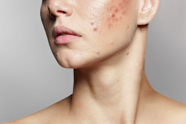 acne niacinamide 