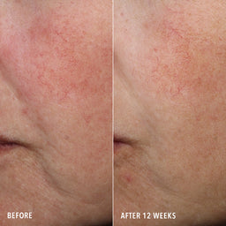 HydroPeptide Syner-C Before & After Redness