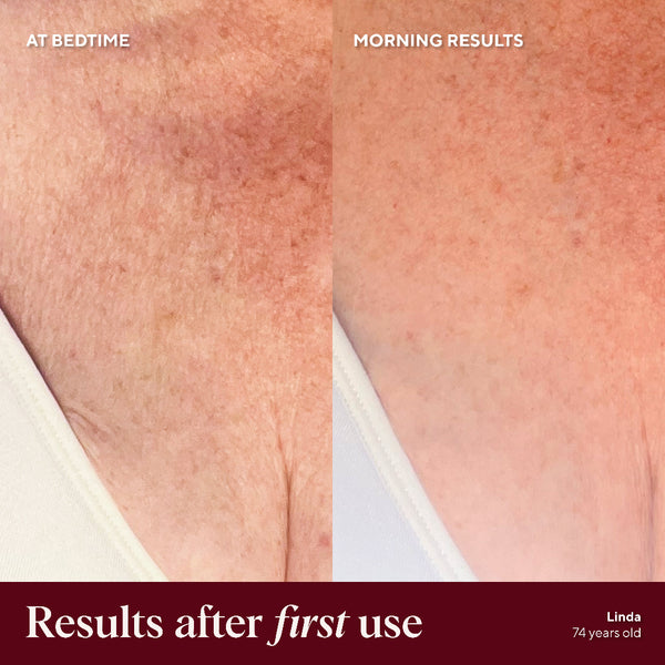 Before and after comparison of skin texture on a person's shoulder, labeled 'At Bedtime' and 'Morning Results'.
