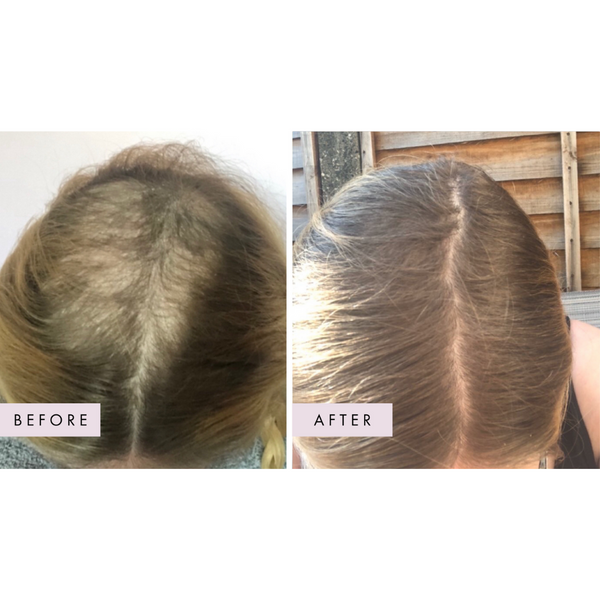 Before and after comparison of a person's hairline with 'Before' on the left and 'After' on the right.