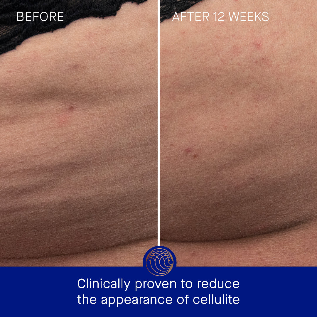 Before and after comparison of cellulite reduction on skin with text indicating clinical provenance.