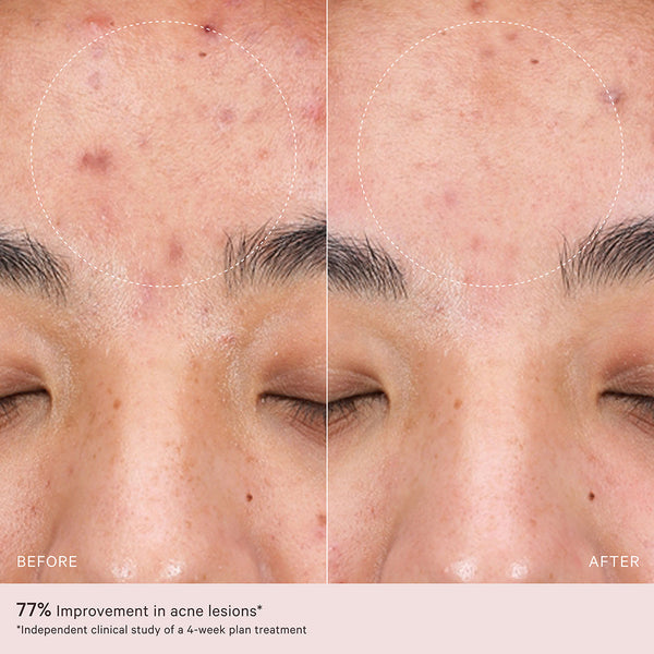 MZ SKIN LED 2.0 LightMAX Supercharged LED Mask