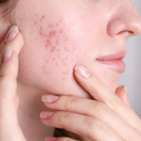 Acne Prone Skin