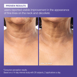 Before and after comparison of neck and décolleté with visible improvement in fine lines.