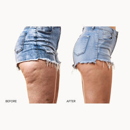 Before and after comparison of a person's upper leg and hip area wearing light-wash denim shorts, shown against a plain light background. The left side is labeled BEFORE and shows fuller skin; the right side is labeled AFTER and shows smoother skin.