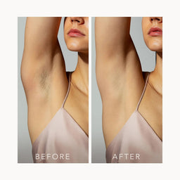 A side-by-side before and after comparison showing a woman's underarm area, with visible dark underarm hair on the left and clearer skin on the right. The woman wears a pale pink satin camisole against a light gray background, with the words BEFORE and AFTER overlaid at the bottom of each panel.